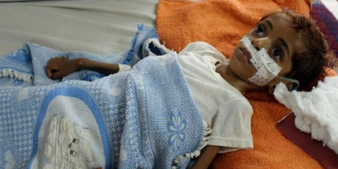 أطفال اليمن يعيشون جحيم الجوع والمرض بسبب عدوان النظام السعودي